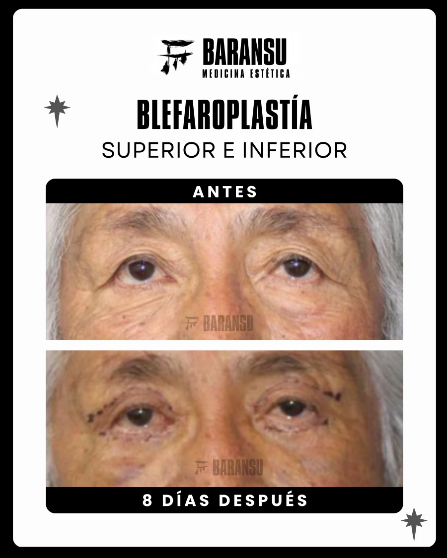 Blefaroplastía Superior e Inferior 