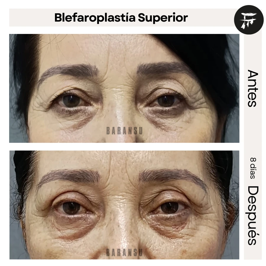 Blefaroplastía Superior