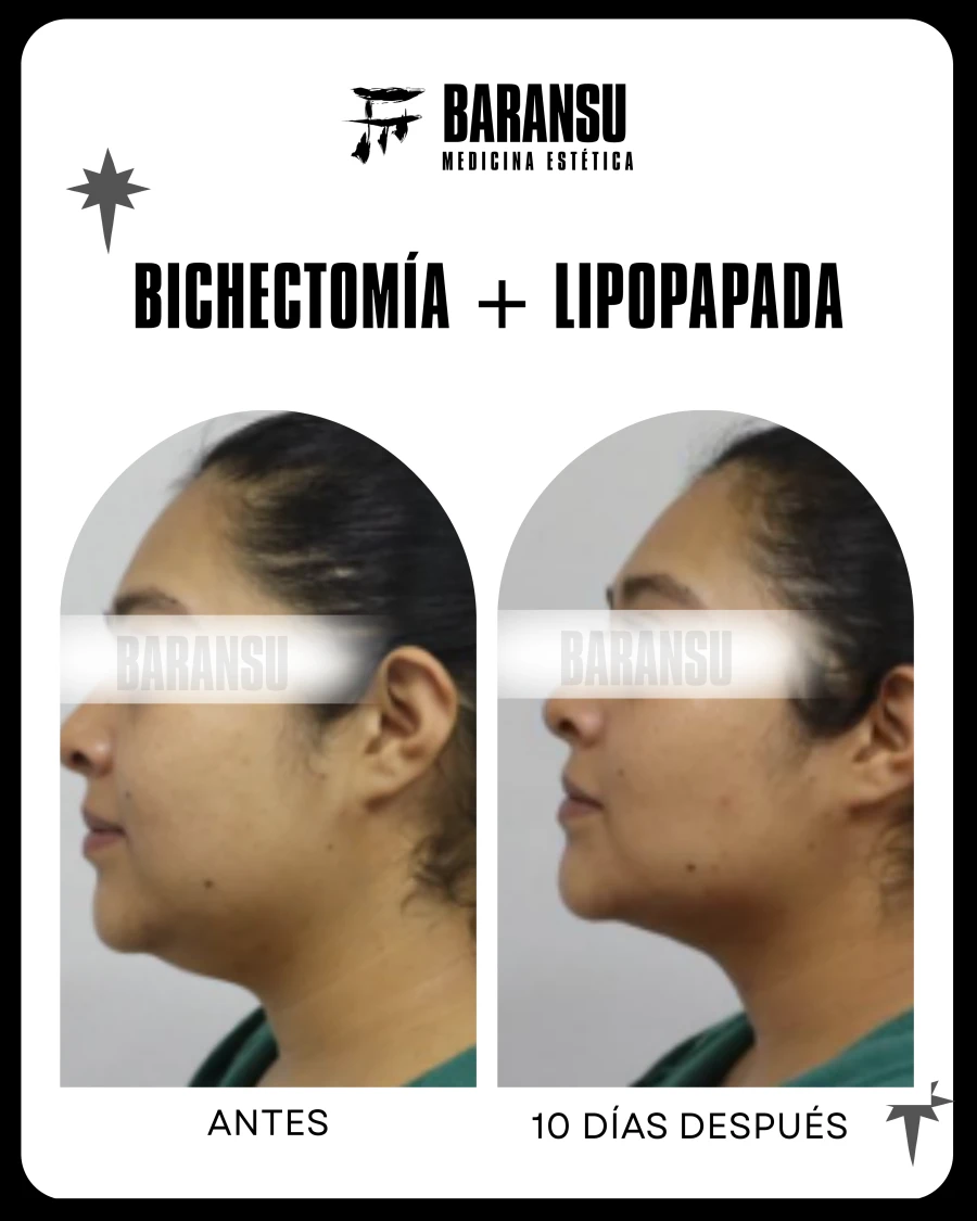 Lipo de Papada 19