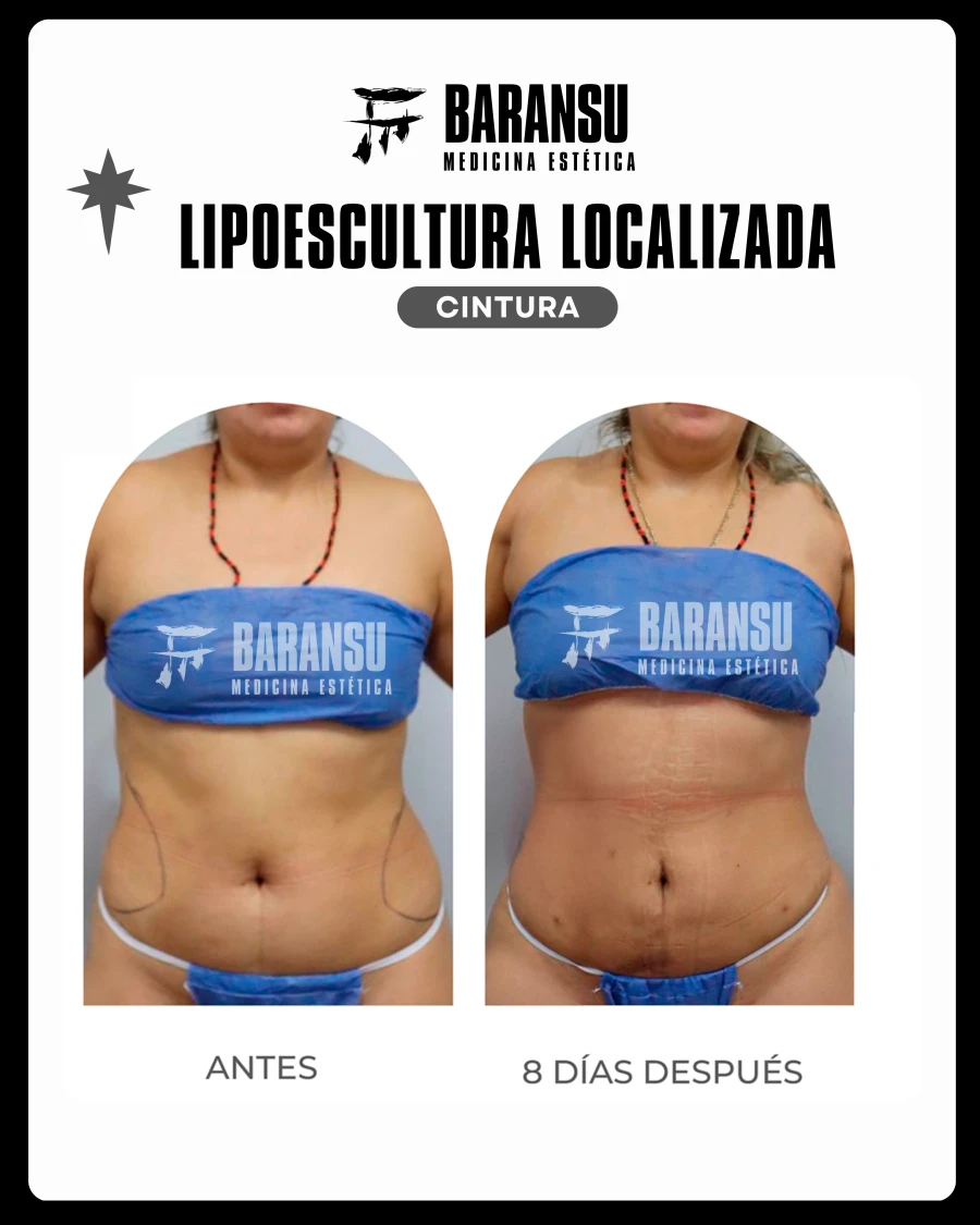 Lipoescultura Localizada (Minilipo) 25