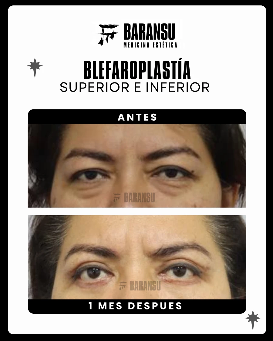 Blefaroplastía Superior e Inferior 4