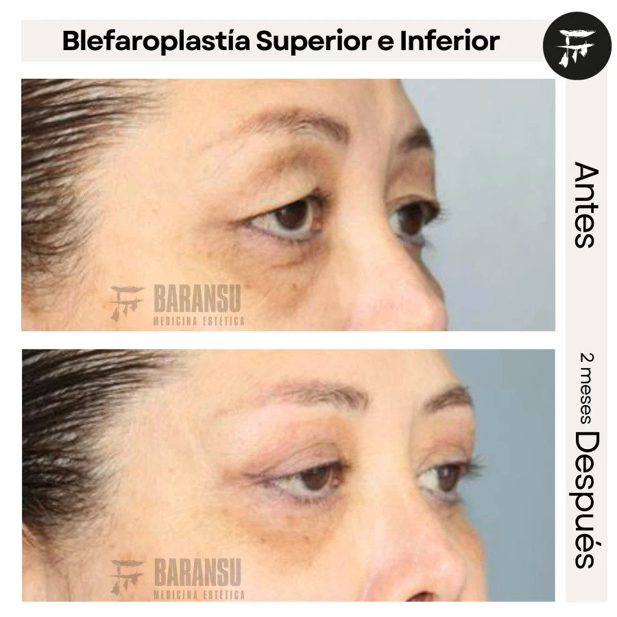 Blefaroplastía Superior e Inferior