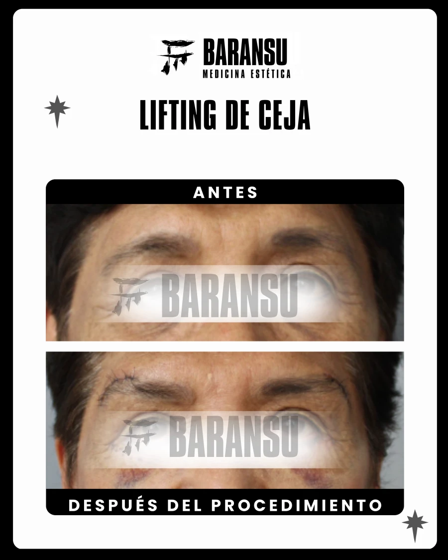 Lifting de ceja 1