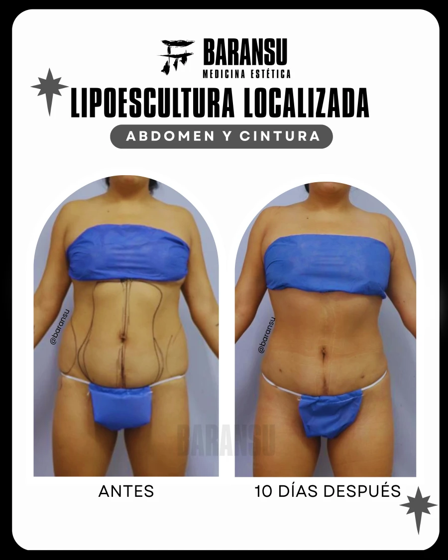 Lipoescultura Localizada (Minilipo) 11
