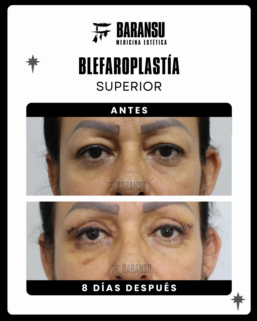 Blefaroplastía Superior