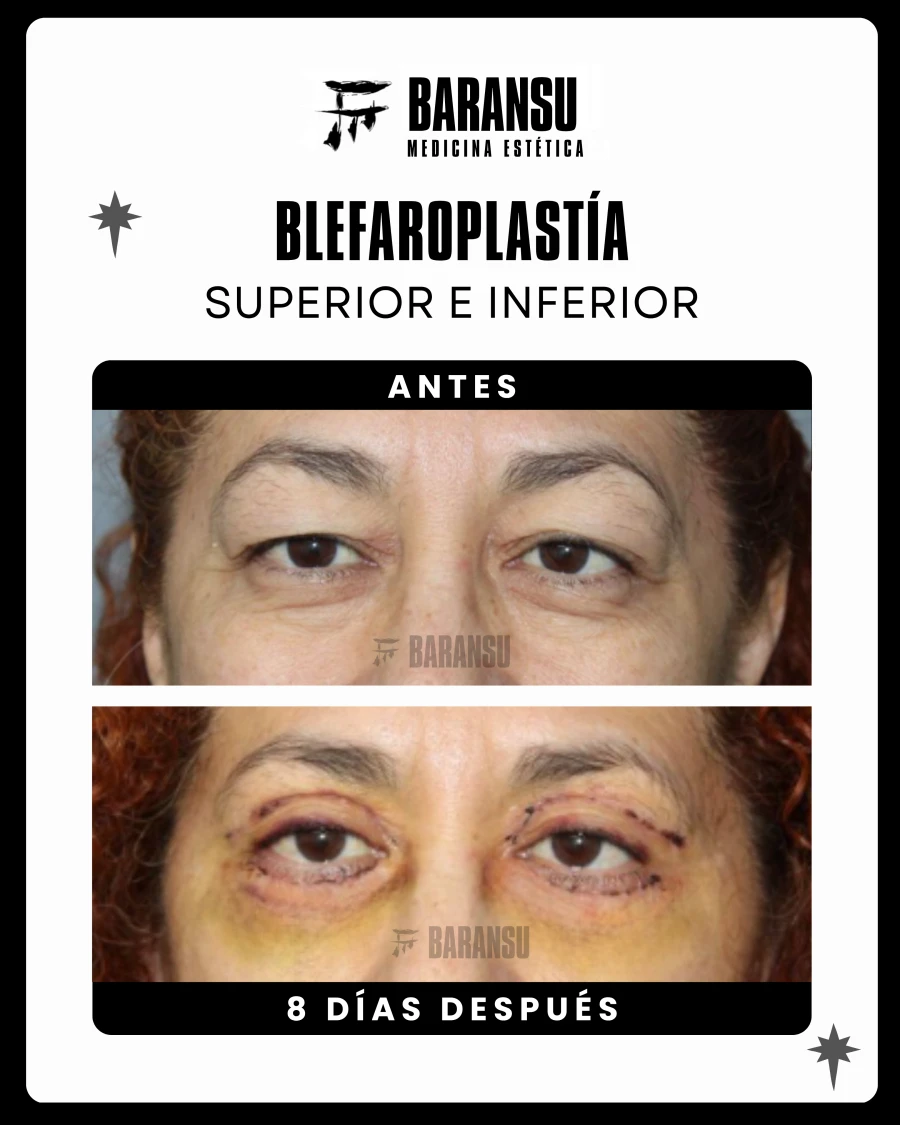 Blefaroplastía Superior e Inferior