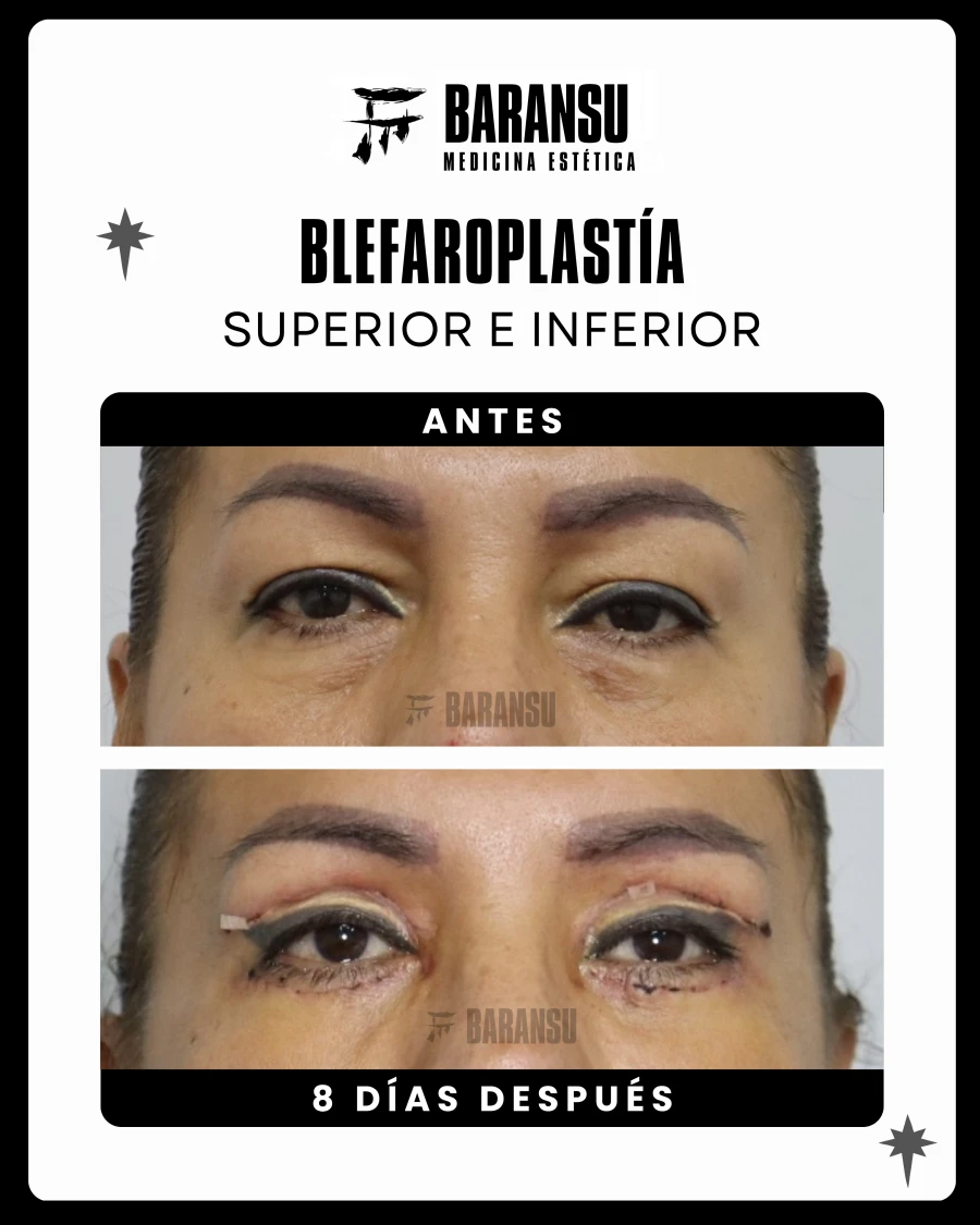 Blefaroplastía Superior e Inferior 