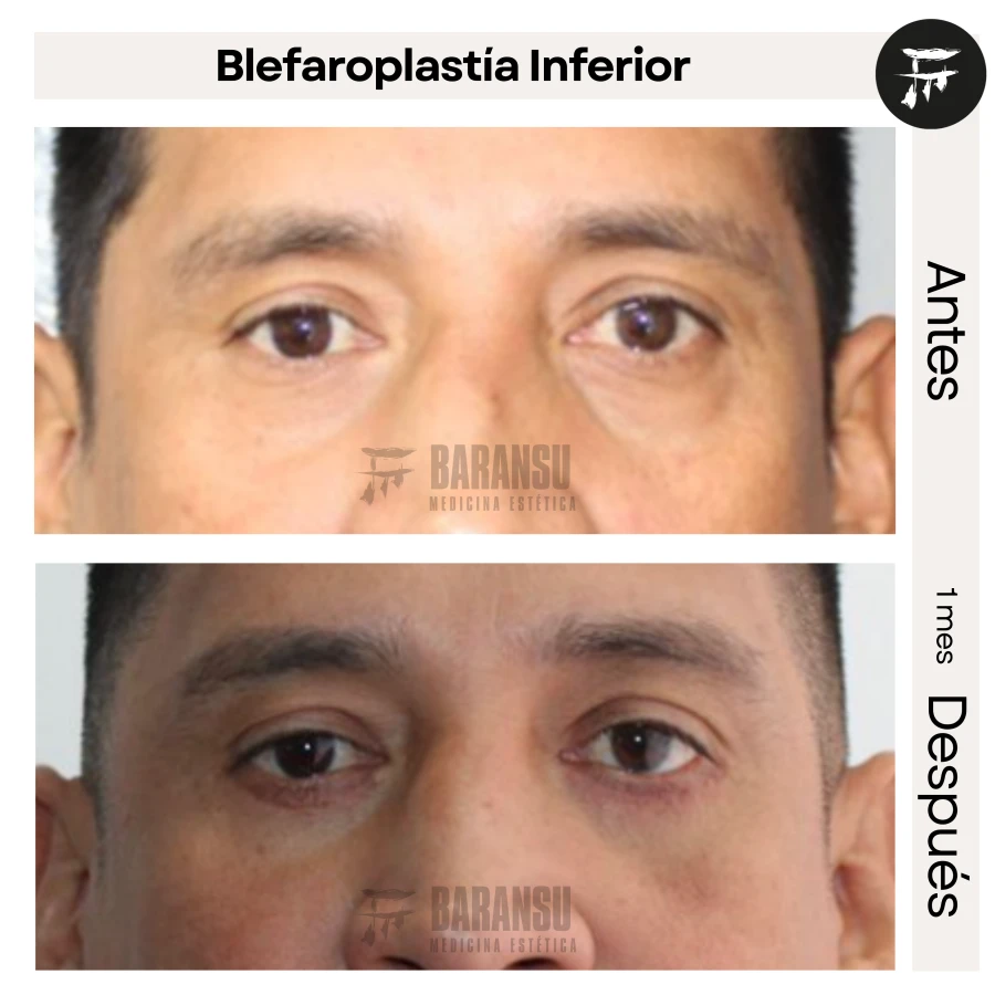 Blefaroplastía Inferior
