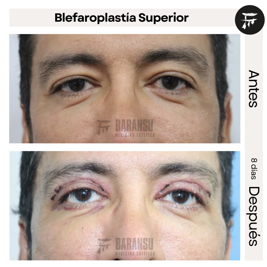Blefaroplastía Superior