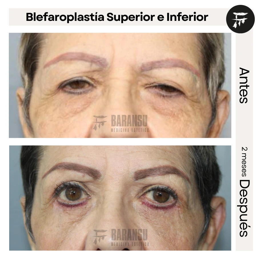 Blefaroplastía Superior e Inferior