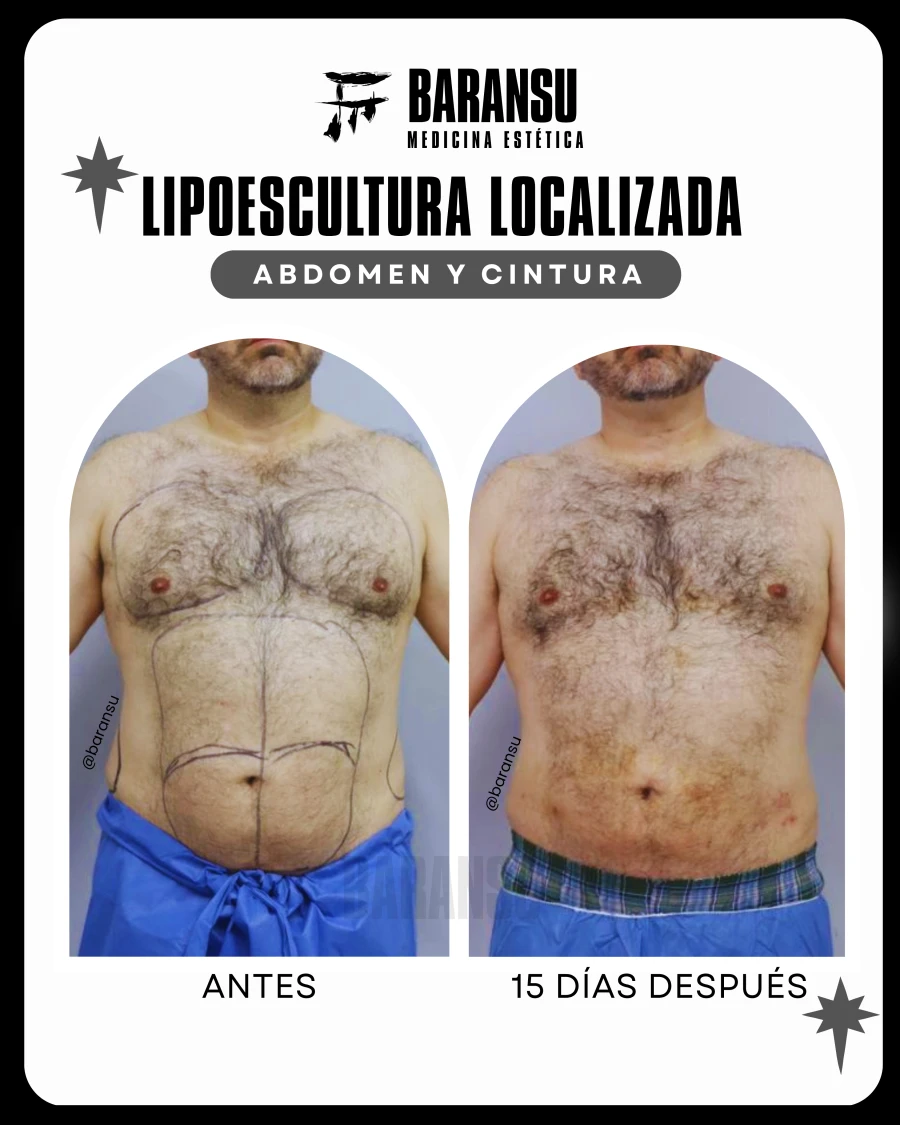 Lipoescultura Localizada (Minilipo) 21