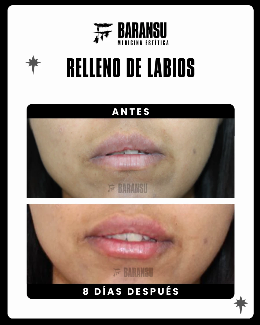 Relleno de Labios 10