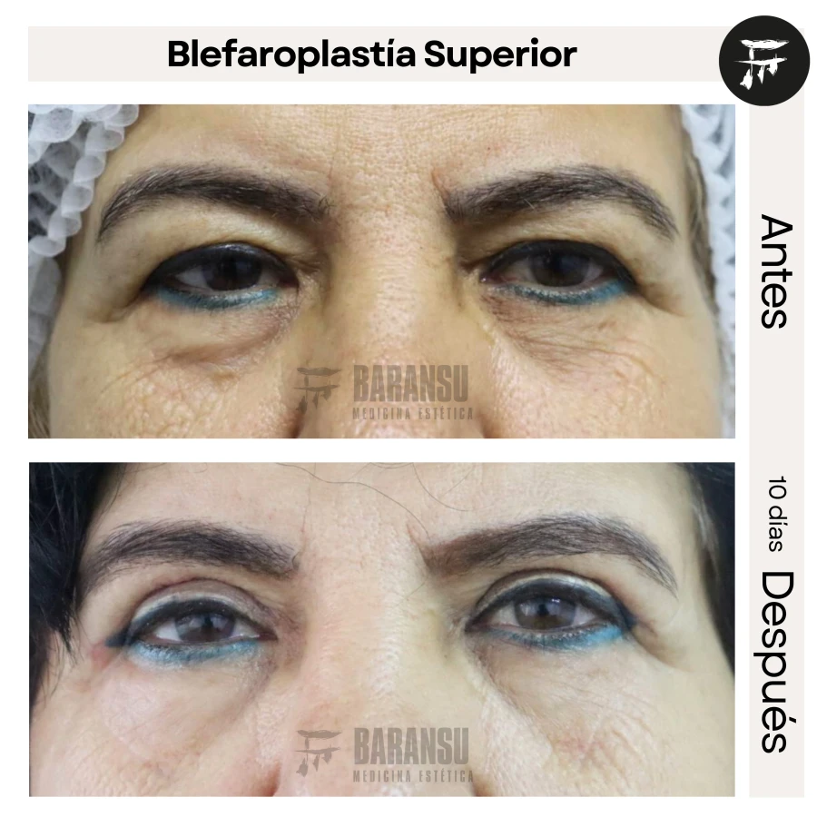 Blefaroplastía Superior