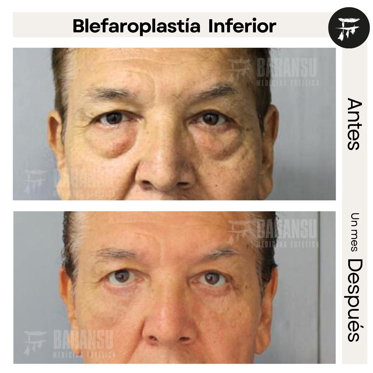 Blefaroplastía Inferior 38
