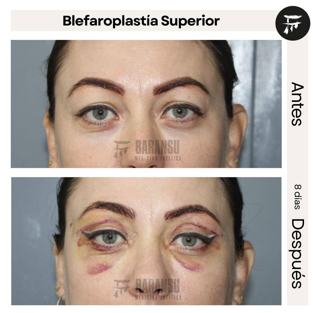 Blefaroplastía Superior 39