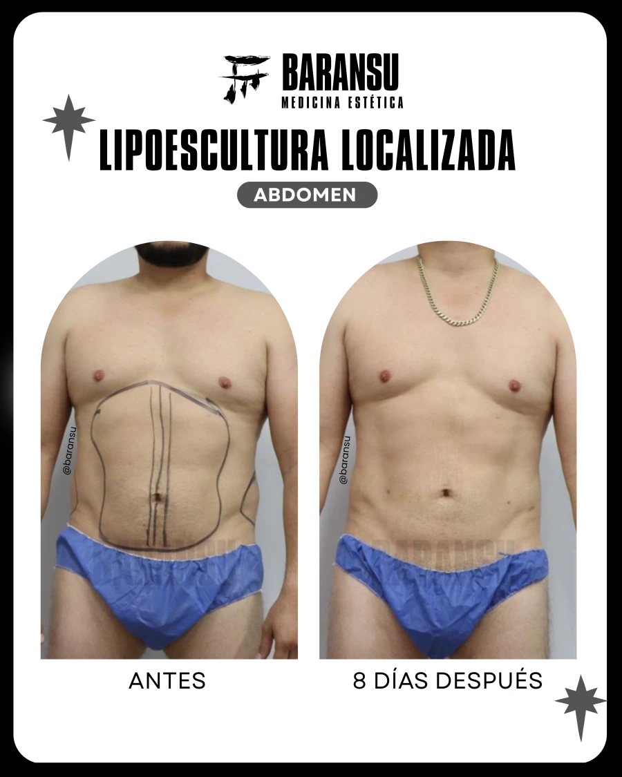 Lipoescultura Localizada (Minilipo) 37