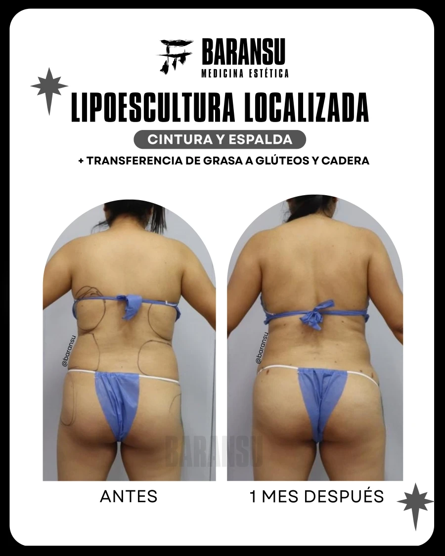 Lipoescultura Localizada (minilipo) 42