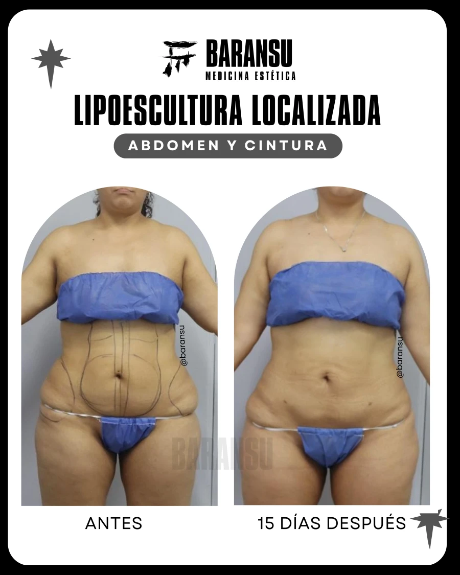 Lipoescultura Localizada (Minilipo) 9