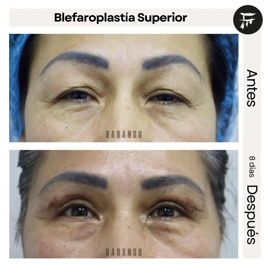 Blefaroplastía Superior