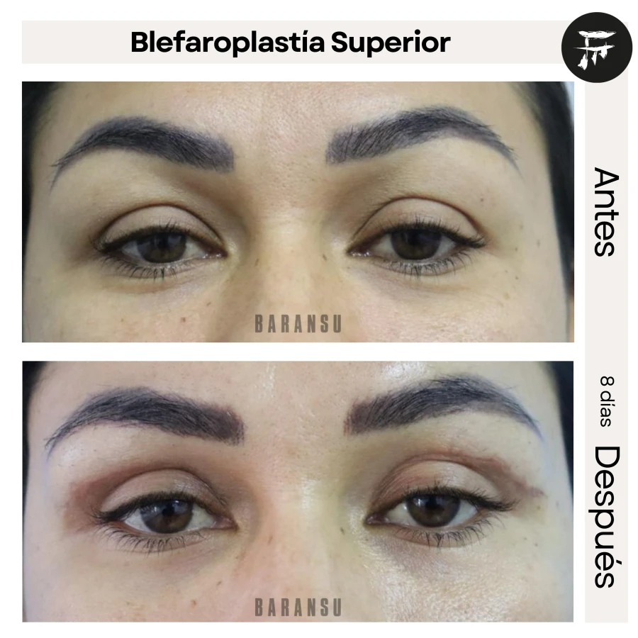 Belfaroplastía Superior