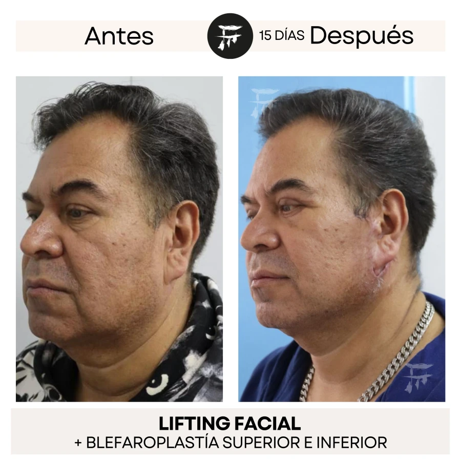Lifting Facial + Blefaroplastía Superior e Inferior