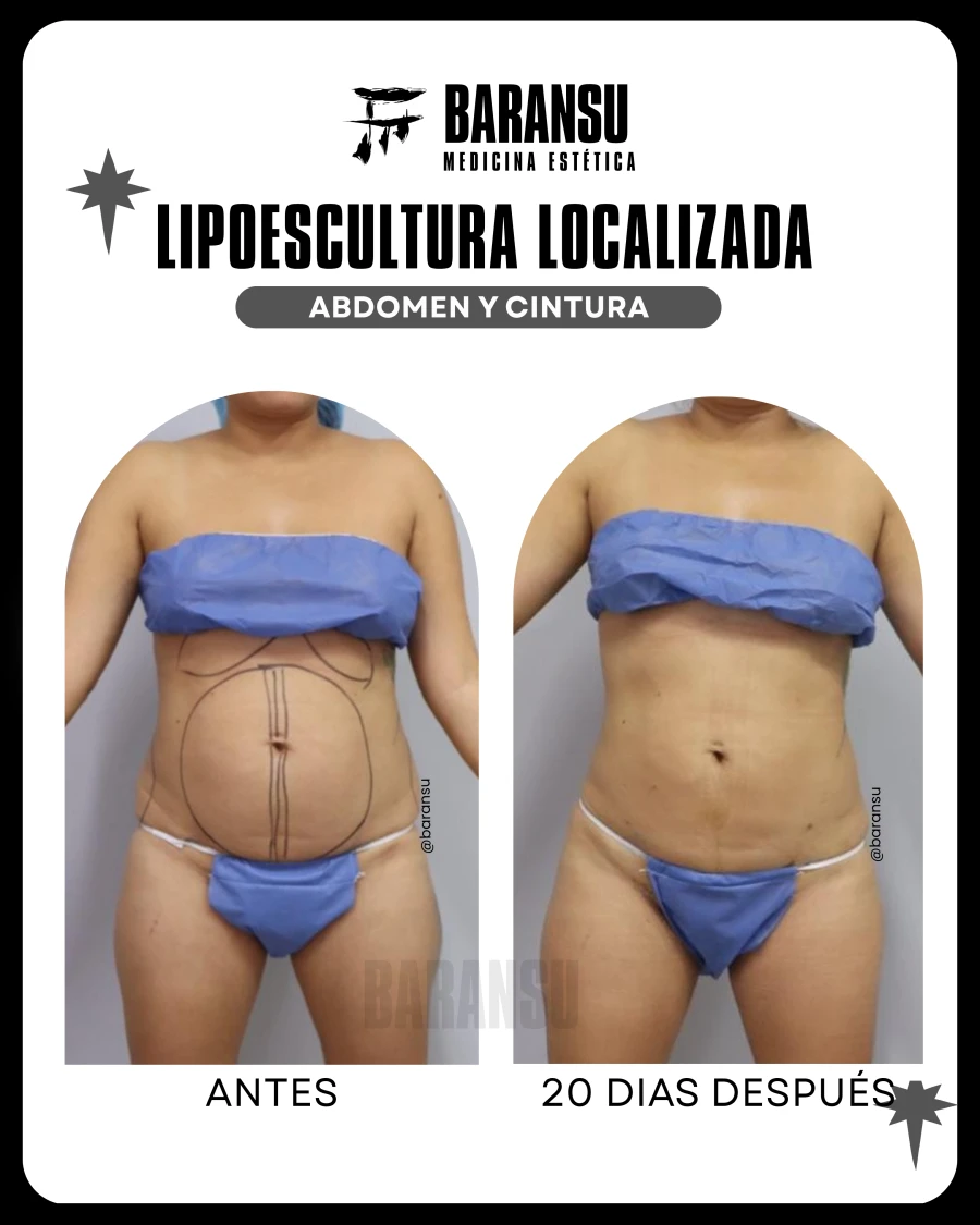 Lipoescultura Localizada (Minilipo) 47