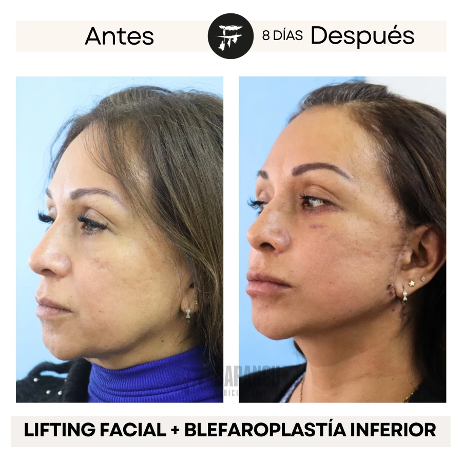 Lifting Facial +  Blefaroplastía Inferior
