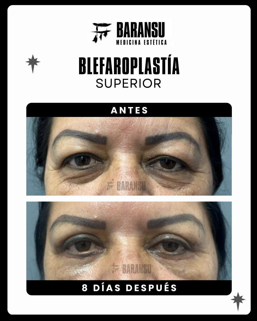 Blefaroplastía Superior