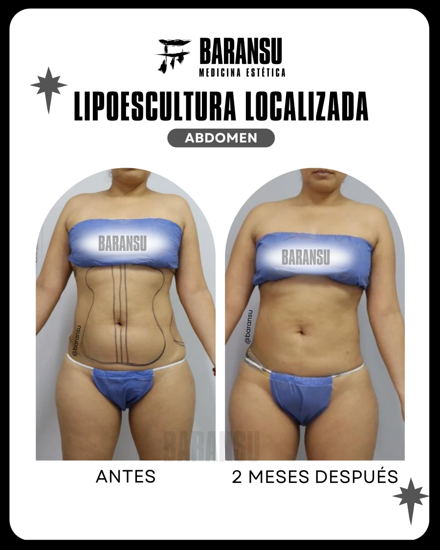 Lipoescultura Localizada (Minilipo) 40